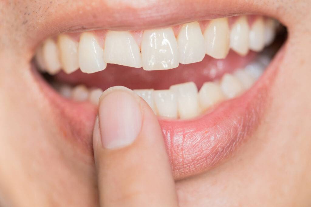 how to fix a chipped tooth